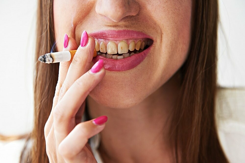Можно ли курить после отбеливания зубов