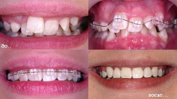 Гигиена и отбеливание зубов