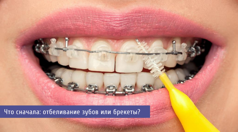 Безопасно ли профессиональное отбеливание зубов? – клиника Ортодонтика, Москва