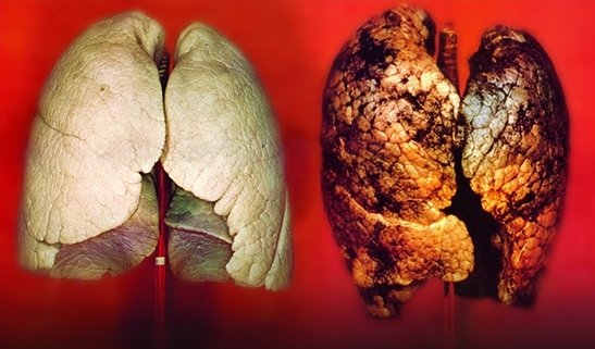 fatal-lung-cancer